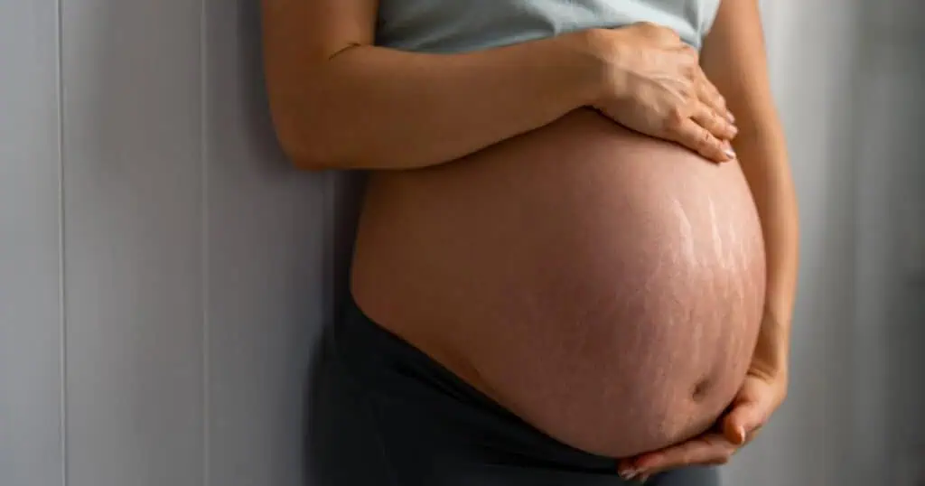stretch marks during pregnancy
